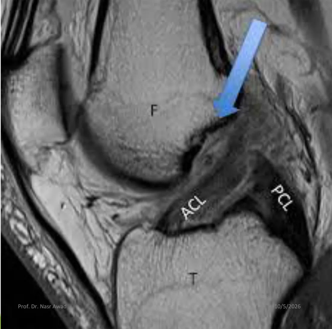 Slide 61 — MRI labelled F, ACL, PCL, T