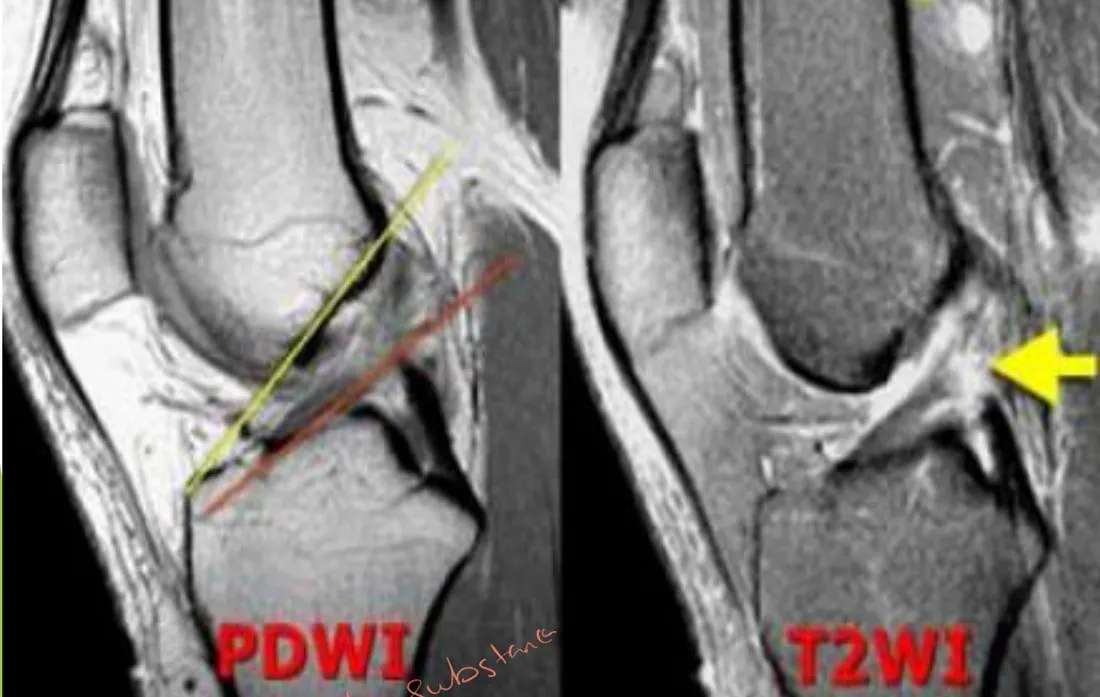 Slide 63 — PDWI and T2WI MRI