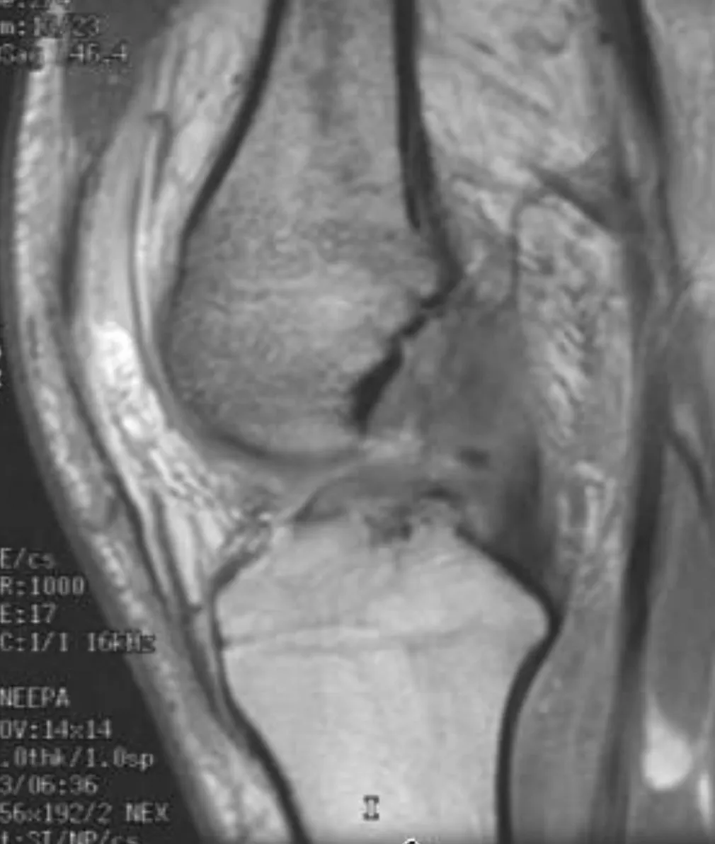Slide 65 — complete tear ACL