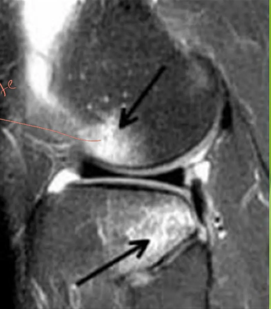 Slide 66 — lateral femoral and tibial bruises with ACL tear