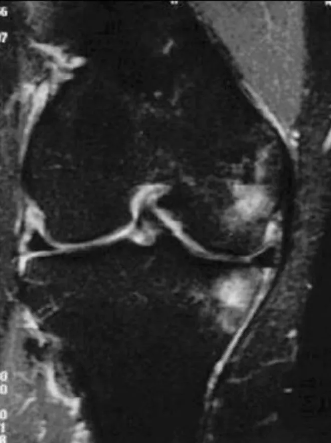 Slide 67 — lateral femoral and tibial bruises with ACL tear