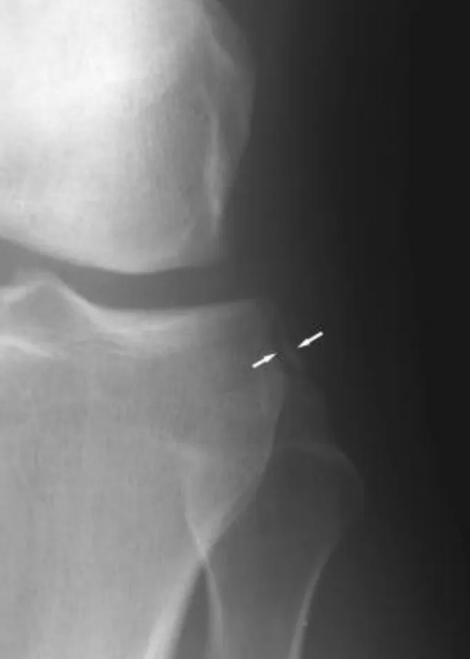 Slide 68 — Segond fracture associated with ACL tear