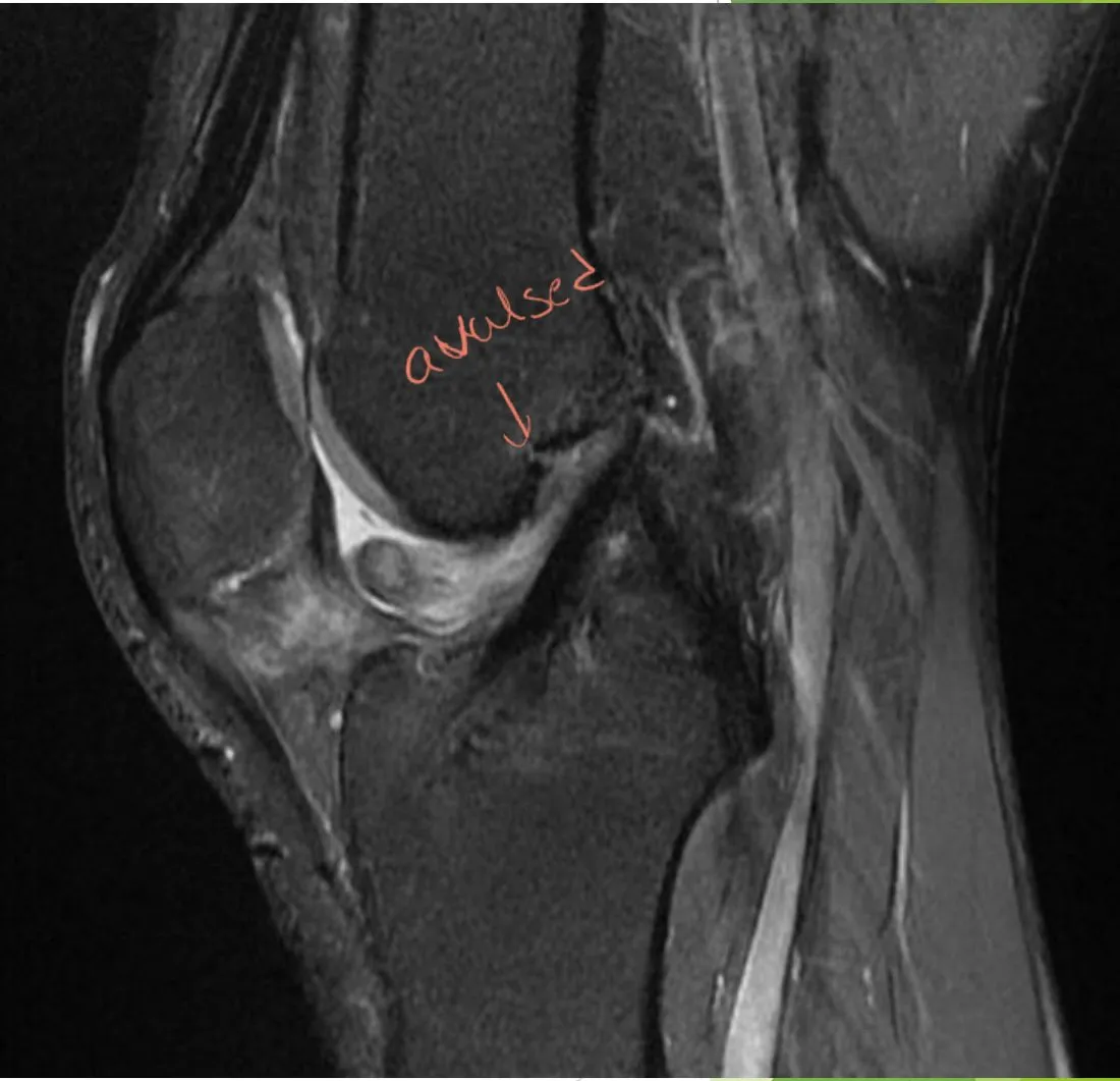 Slide 69 — ACL complete tear