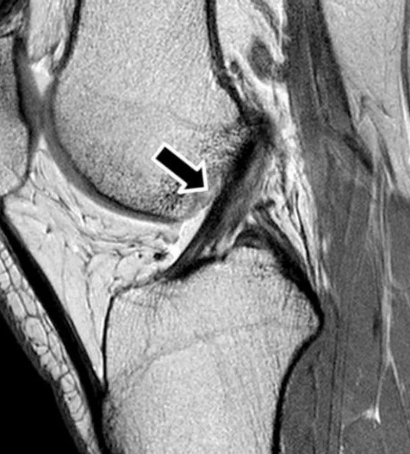 Slide 70 — ACL normal
