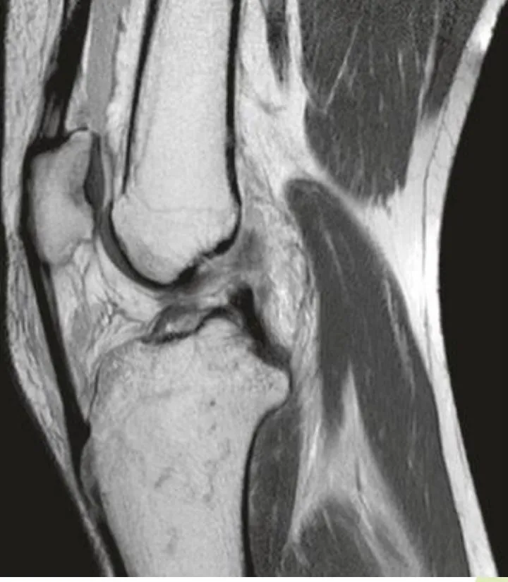 Slide 71 — ACL complete tear