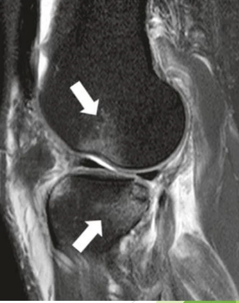 Slide 72 — bone marrow edema