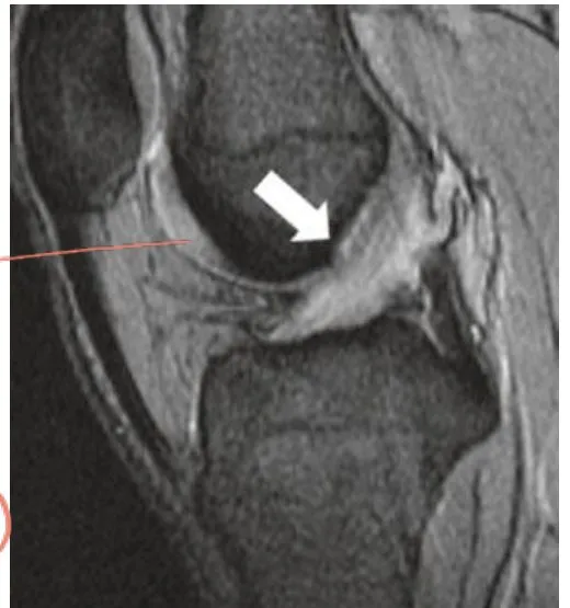 Slide 73 — partial tear ACL