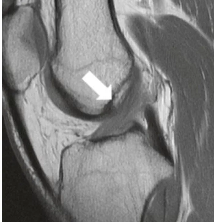 Slide 74 — partial ACL tear