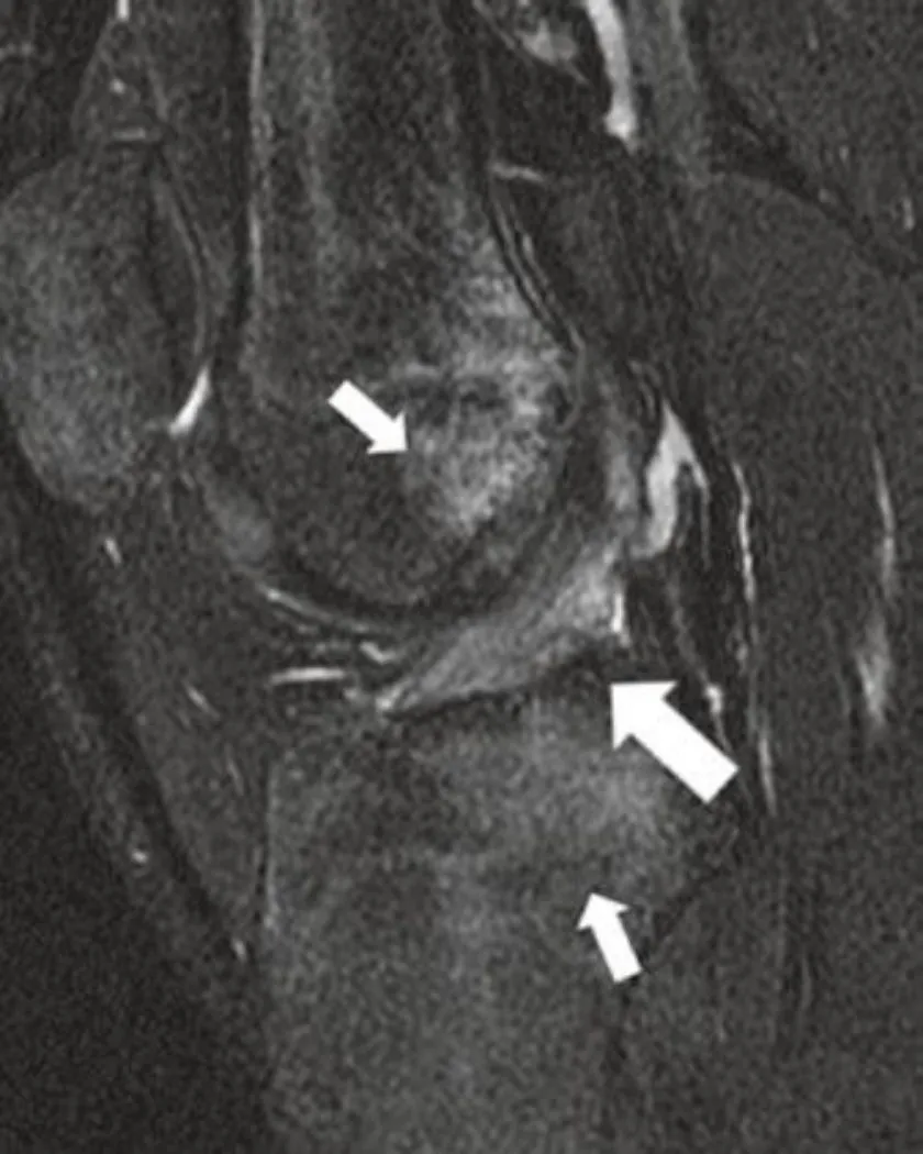 Slide 75 — partial ACL tear with lateral femoral and tibial bruises
