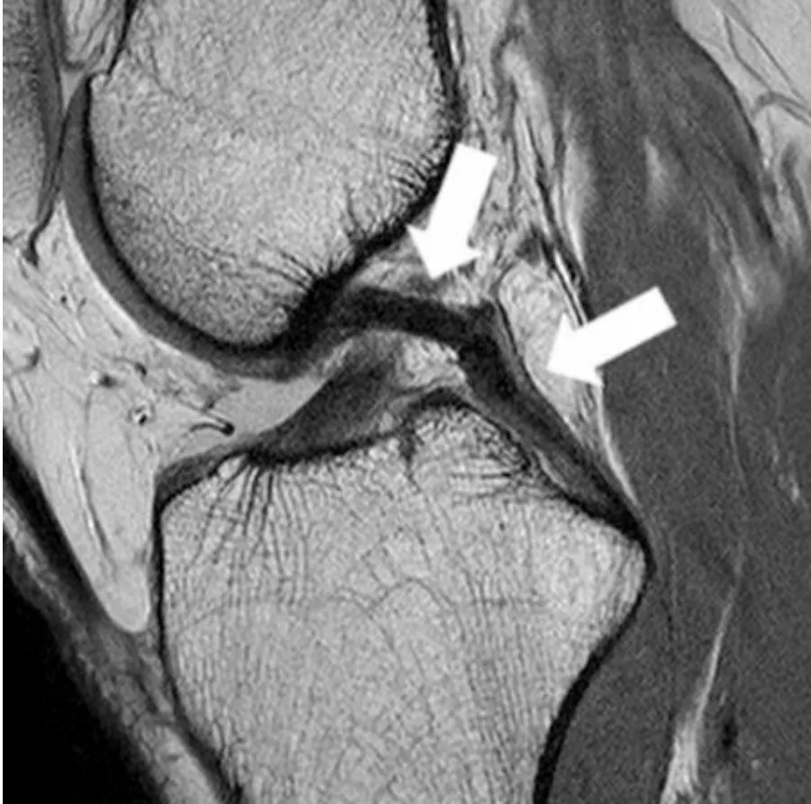 Slide 76 — normal PCL