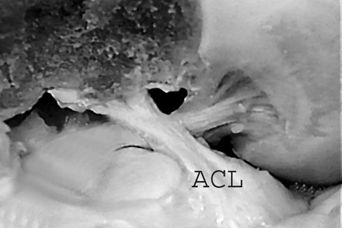 Slide 9 — photo labelled ACL
