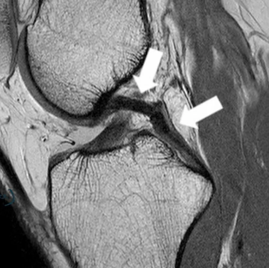 Slide 21 — normal PCL (arrow), sagittal PD-weighted MR image