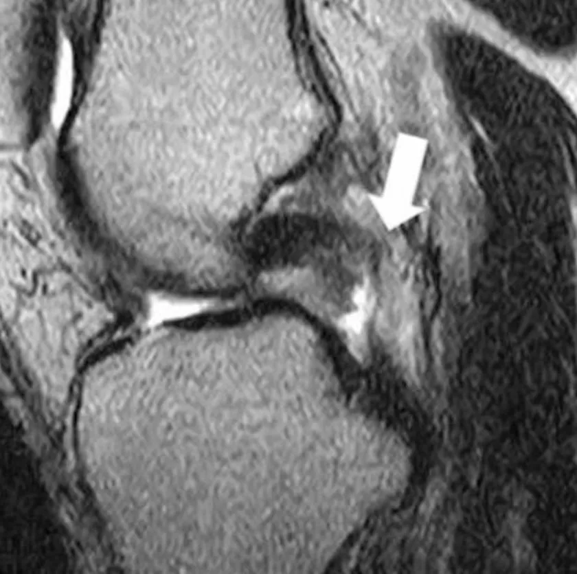Slide 22 — complete PCL tear (arrow), sagittal PD-weighted MR image