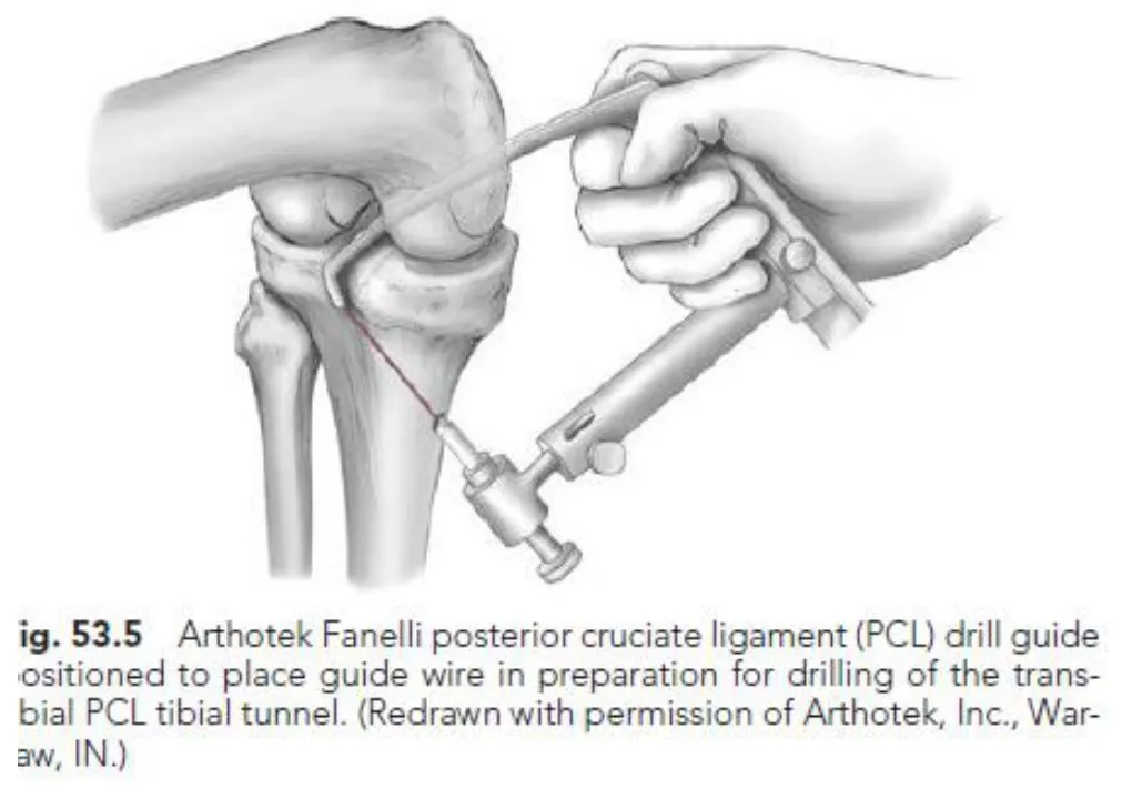 Slide 25 — Fig. 53.5 PCL drill guide for the trans-tibial tunnel