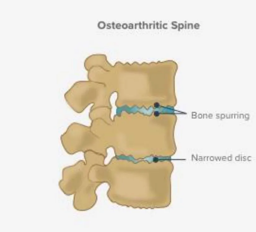 Slide 16 — osteoarthritic spine