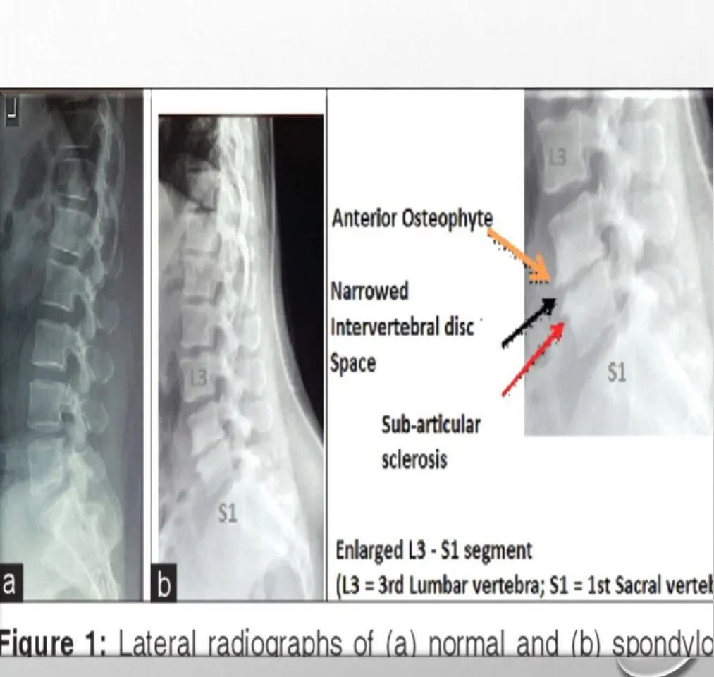 Slide 18 — lateral X-rays, normal vs spondylosis