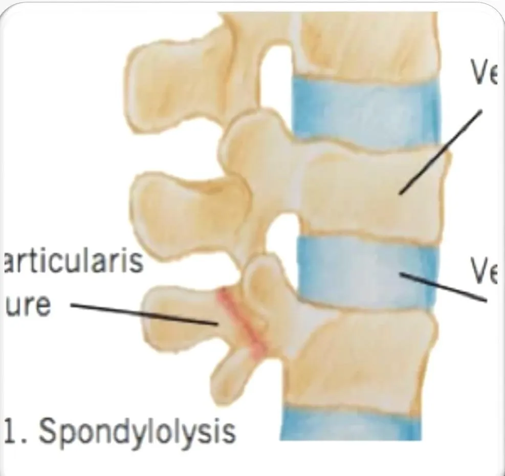 Slide 23 — spondylolysis