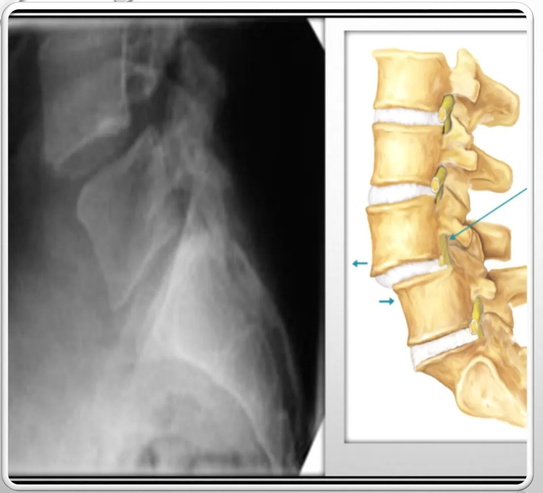 Slide 26 — spondylolisthesis