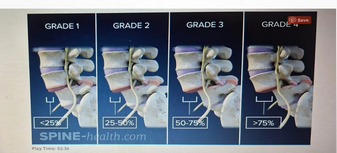 Slide 28 — grades of spondylolisthesis