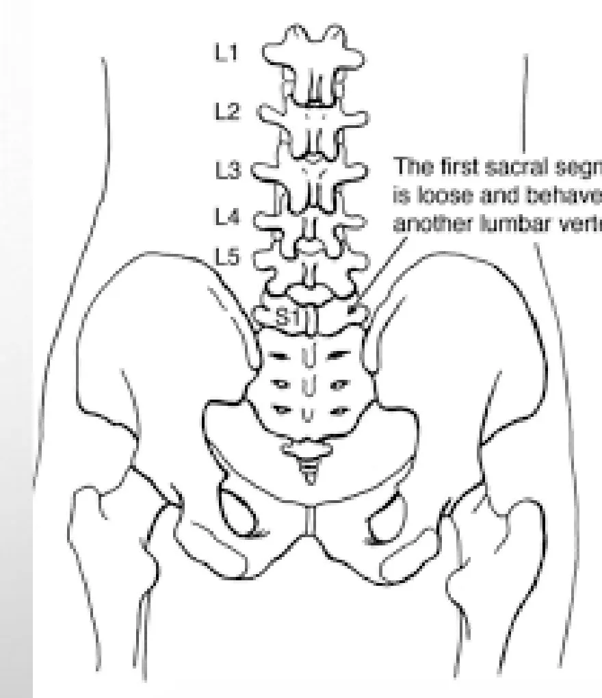 Slide 30 — lumbarization of S1