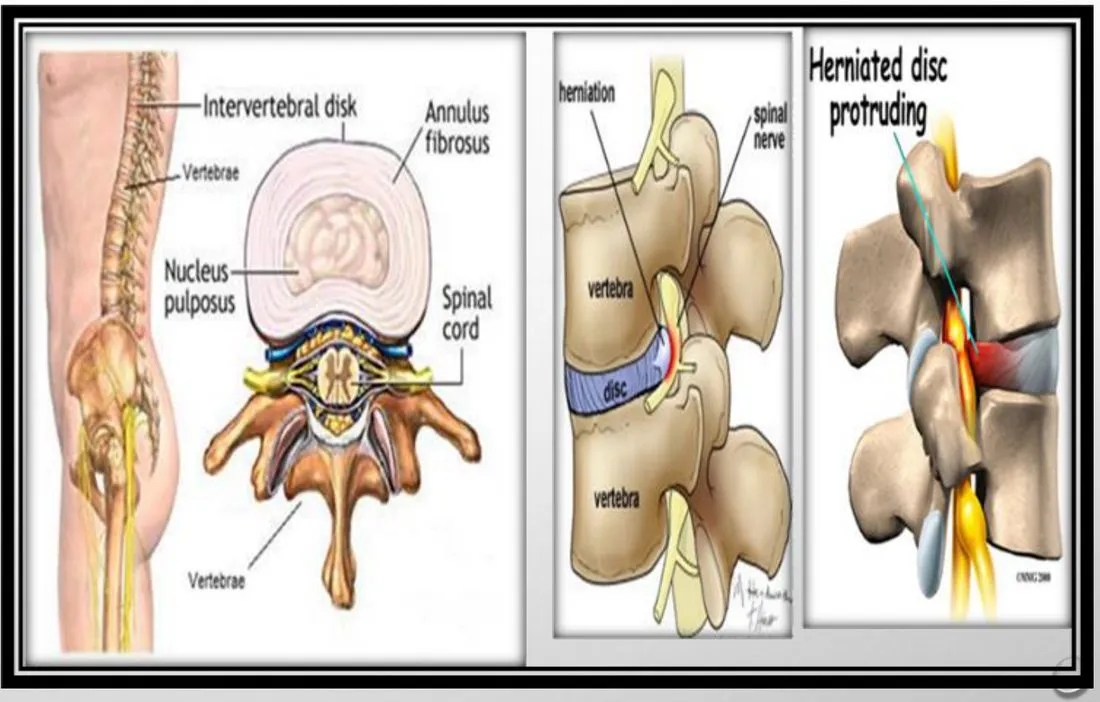 Slide 31 — disc anatomy and herniation
