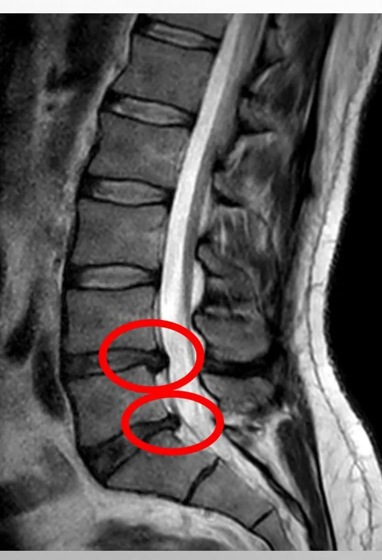 Slide 32 — MRI of disc herniation