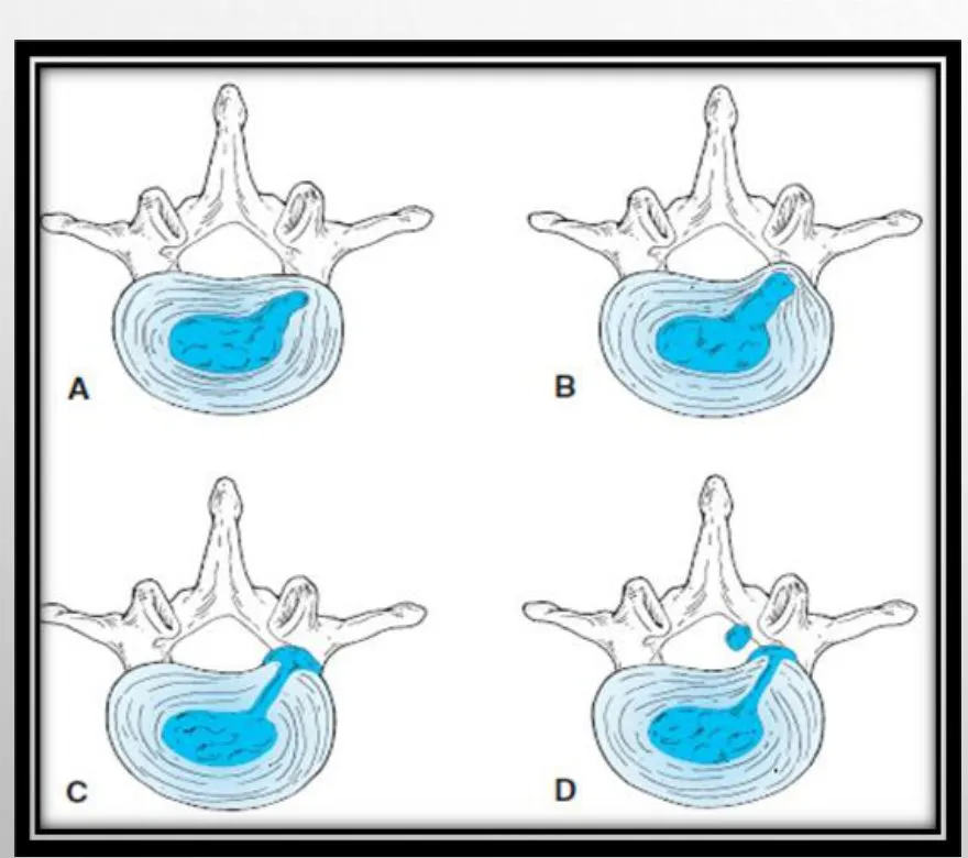 Slide 33 — disc lesion types