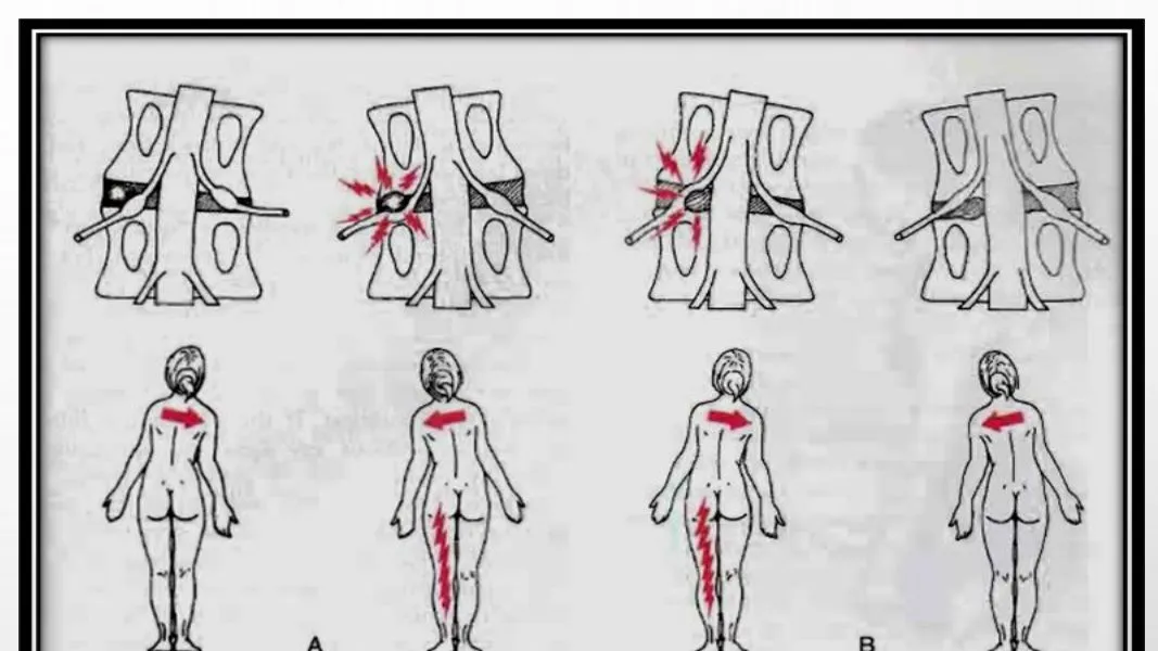 Slide 35 — sciatic shift