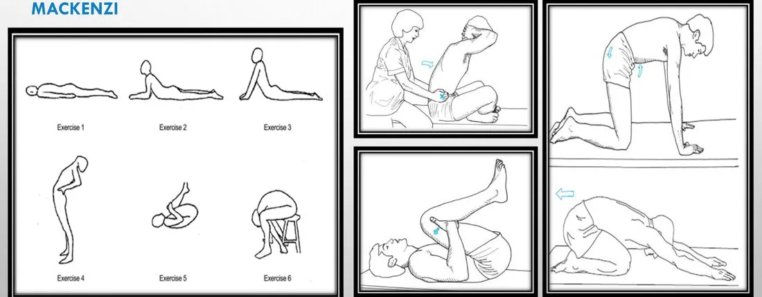 Slide 61 — McKenzie and flexion exercises