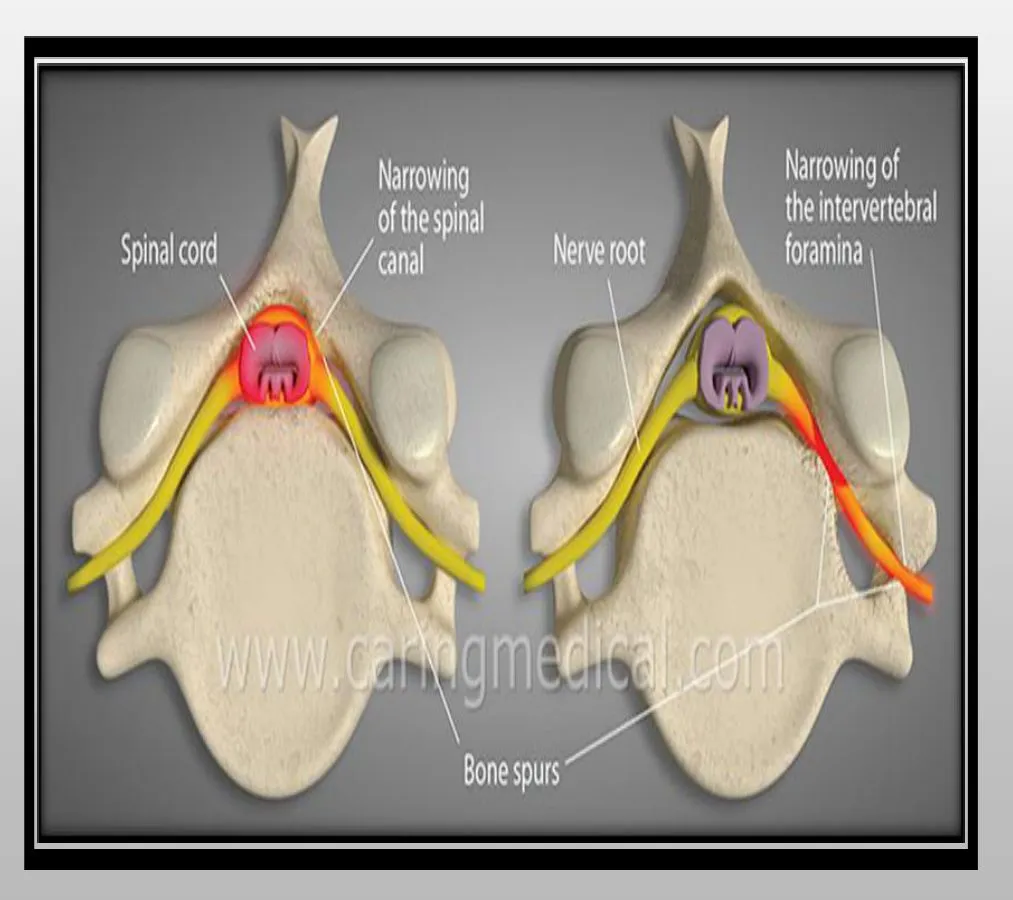 Slide 64 — lumbar spinal stenosis