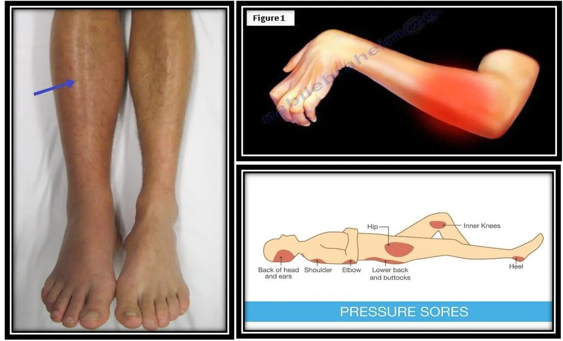 Page 2 — immobilization complications (oedema, pressure sores)