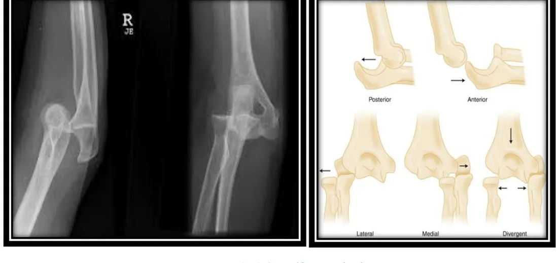 Page 14 — elbow dislocation