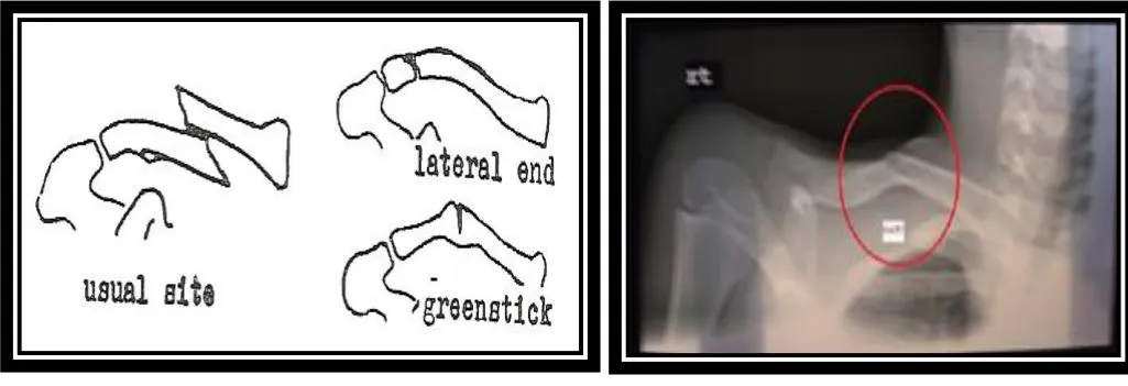 Page 1 — clavicle fracture sites and X-ray