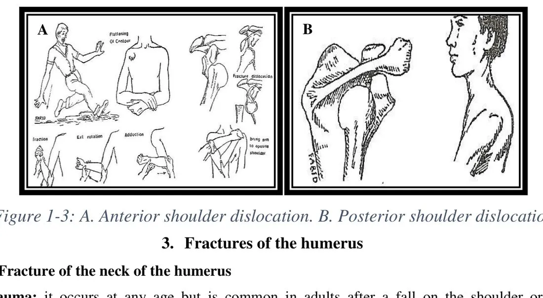 Page 3 — anterior (A) and posterior (B) dislocation