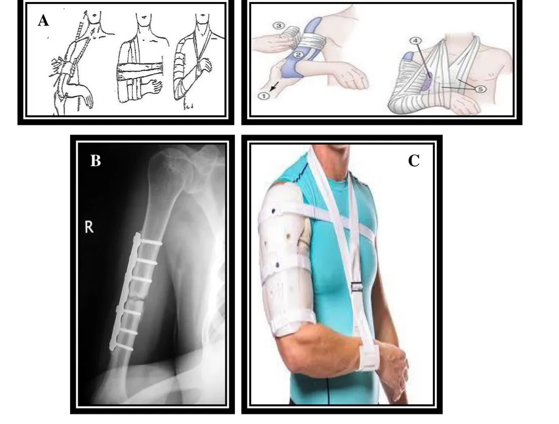 Page 11 — U-slab, plate and screws, Sarmiento brace