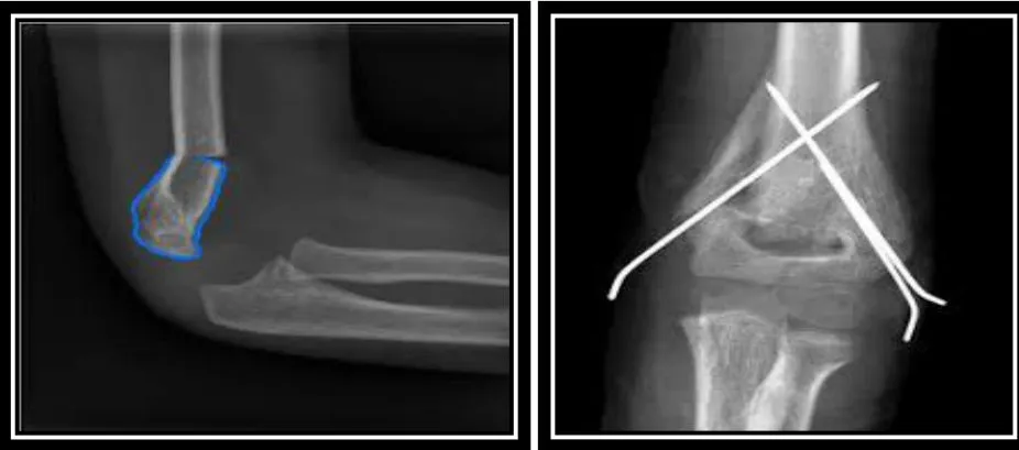 Page 13 — supracondylar fracture and CRPP