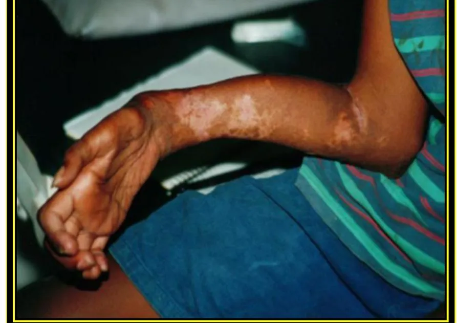 Page 13 — Volkmann’s ischaemic contracture