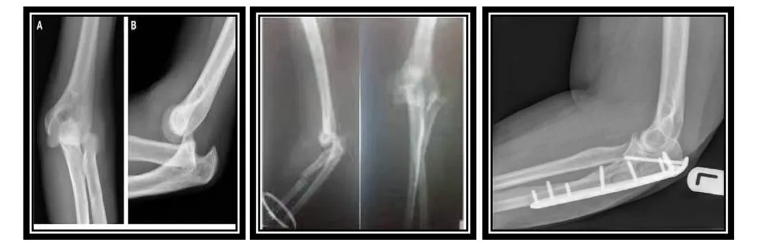 Page 14 — elbow fracture-dislocation and fixation