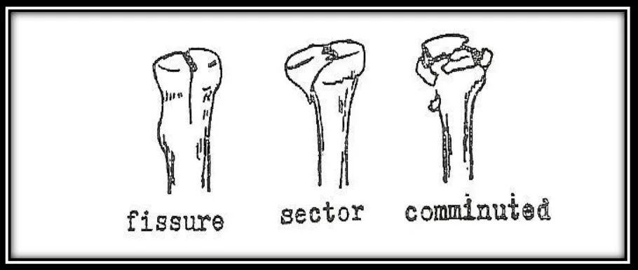 Page 16 — radial head fracture types