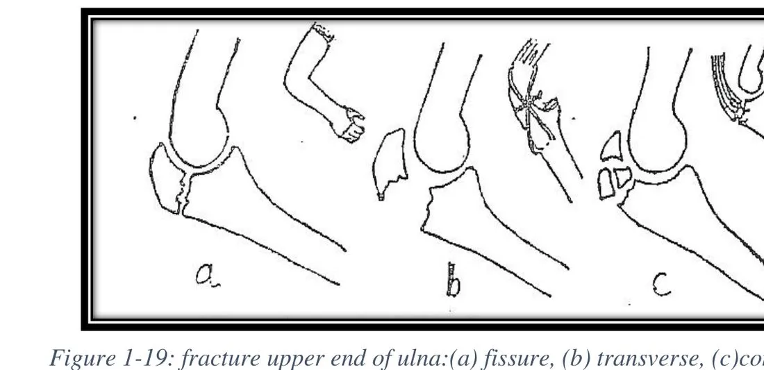 Page 18 — olecranon fracture types