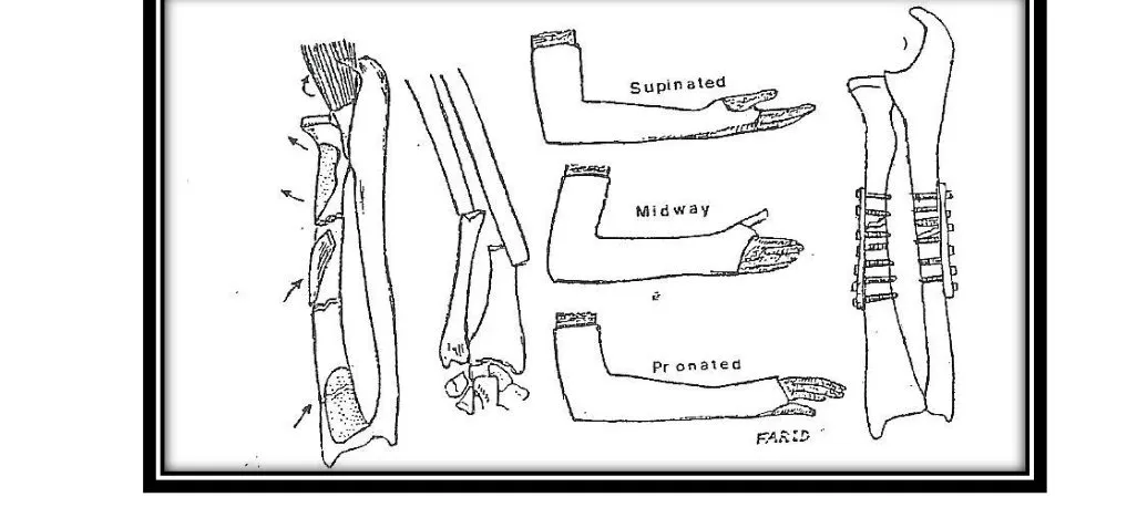 Page 20 — forearm shaft fracture