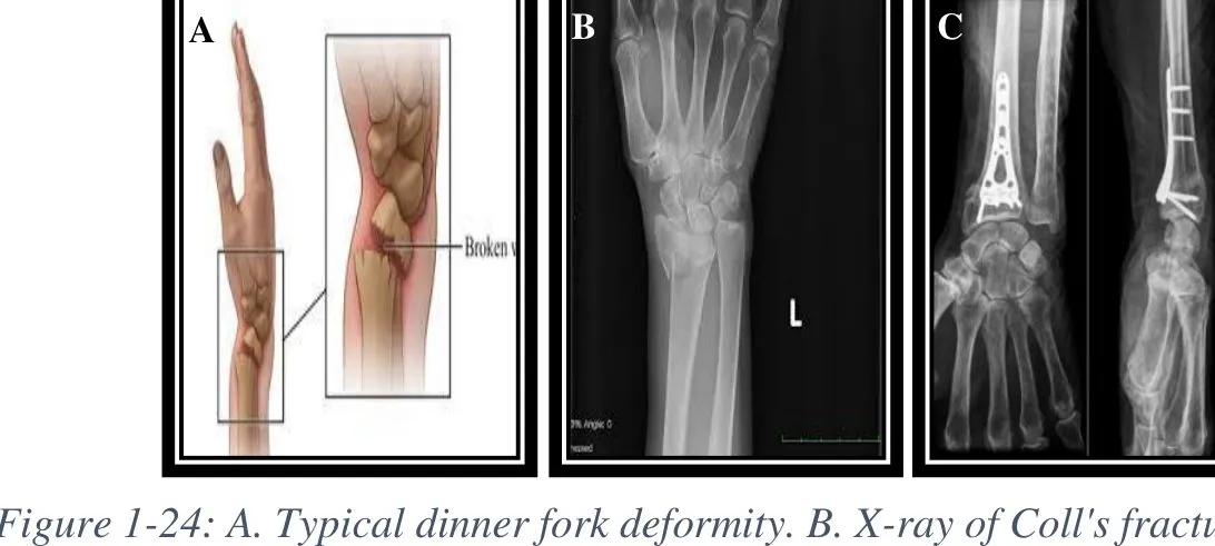 Page 22 — dinner-fork deformity, X-ray, plate fixation