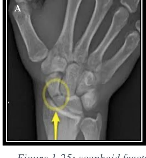 Page 24 — scaphoid fracture
